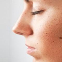 Причини за появата на бенки по лицето
